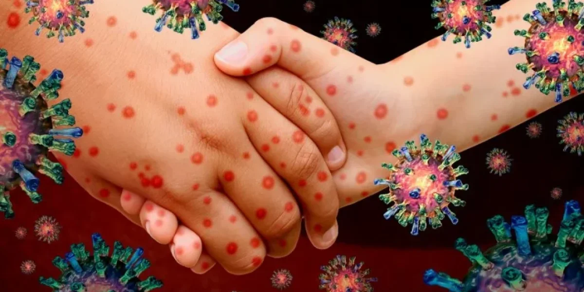 Краснуха возвращается: врачи предупреждают о скрытой угрозе для детей и беременных