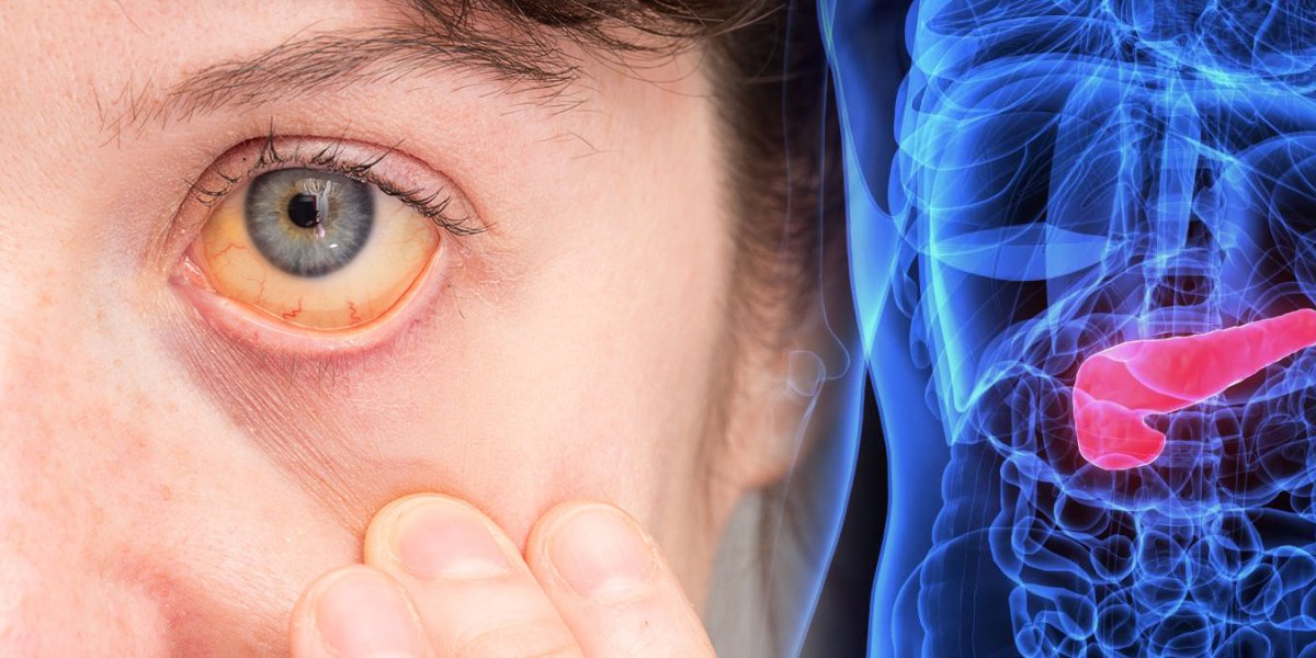 Желтуха: Тревожный сигнал кожи, который может указывать на рак поджелудочной железы