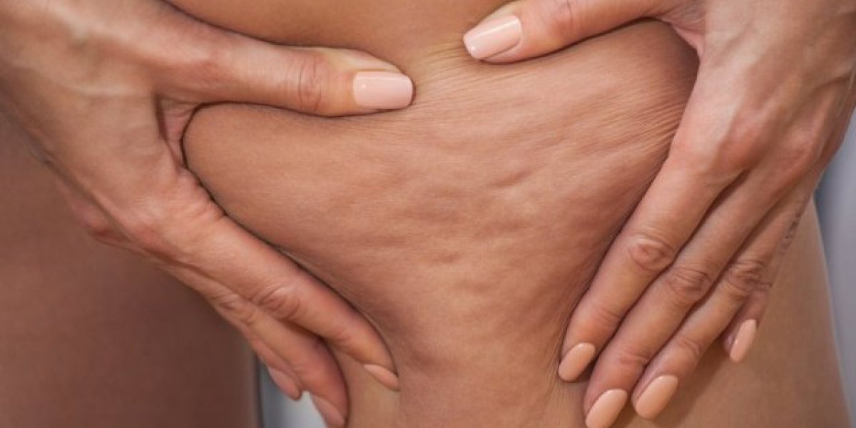 Секрет апельсиновой корки: врачи назвали настоящие причины целлюлита, о которых мало кто знает Секрет апельсиновой корки: врачи назвали настоящие причины целлюлита, о которых мало кто знает